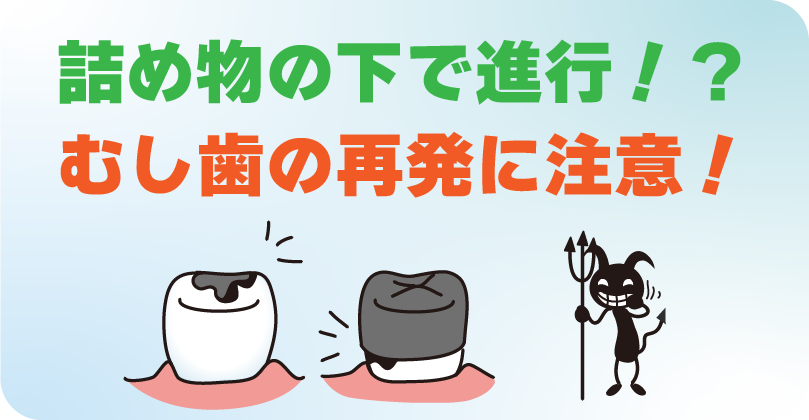 詰め物の下でむし歯が進行