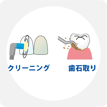 詰め物や被せ物の劣化